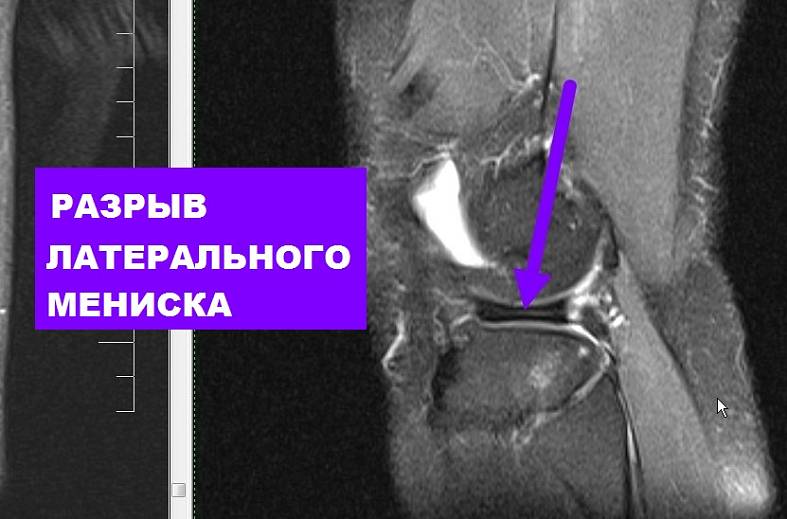 МРТ коленного сустава на 15-канальной катушке