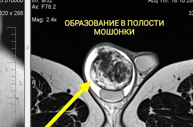 МРТ наружных половых органов (органы мошонки и пенис)